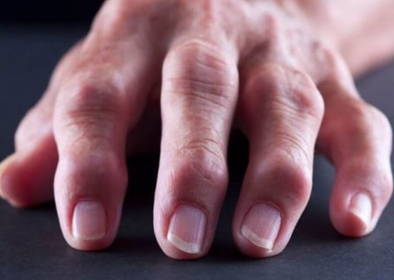 la polyarthrite rhumatoïde comme cause de douleurs articulaires des doigts