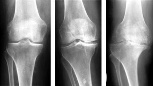 3 stades de l'arthrose de l'articulation du genou